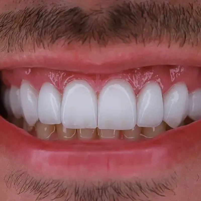 Lentes de Contato Dental Juiz de Fora